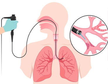 Endobronşiyal Ultrason (EBUS): Akciğerlerin Gizemli Dünyasına Yolculuk
